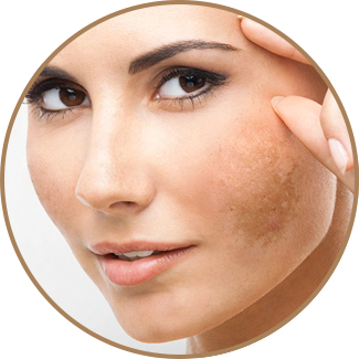 Melasma (paño)